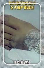 筱筱看社会 因提分手遭男友泼汽油烧伤女子发声:死刑不至于,人活着都不容易