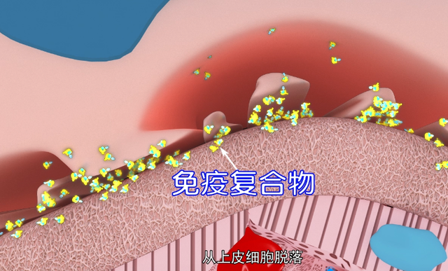 肾病之友|顽固性蛋白尿、复发性蛋白尿，如何解决？