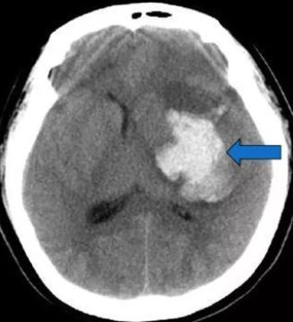 脑血管病|高血压脑出血该怎么办?