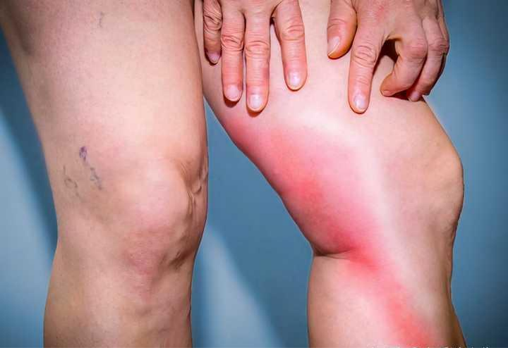 类风湿医生郑家琛|尿酸“超标”,会引发痛风,具体表现是什么?