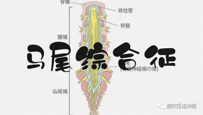 腰椎间盘突出|马尾综合征