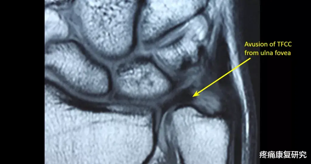 便秘|三角纤维软骨损伤与康复治疗