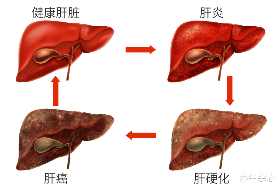 肝癌|26岁男程序员确诊肝癌,医生:身体出现这2个明显异常,趁早查肝CT