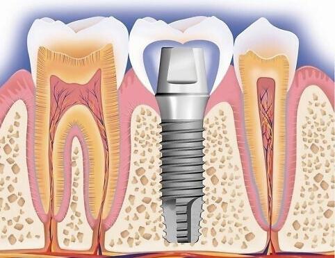 并发症|种植牙在使用期间可能会出现的常见问题盘点
