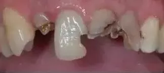 血栓|牙齿烂的只剩牙根，还能补救吗？