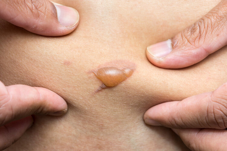 |烫伤急救不惊慌:牢记烫伤“五字经”,别随意听信偏方