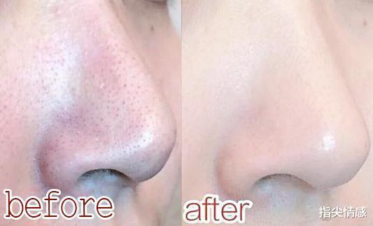 痘痘|国内一“憋屈”洗面奶，因价低遭冷落，用后：黑头，痘痘渐渐消失