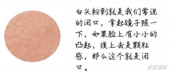 伊美如云|粉刺总会在意想不到的时候出现，一定要避免这些坑