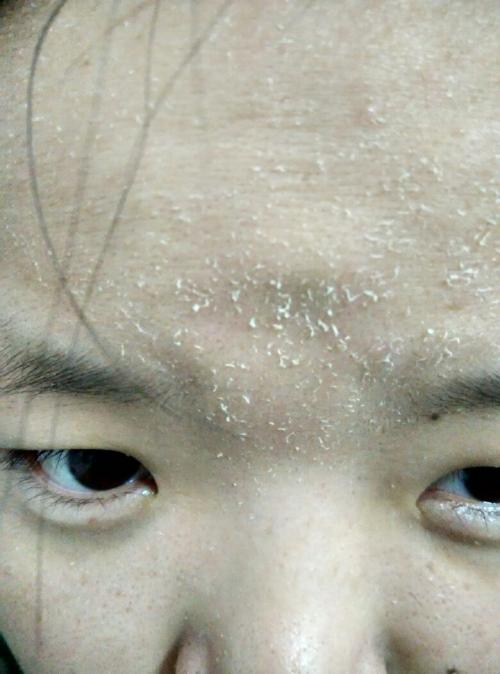 皮炎 怎么补水都还是起皮?脸上的这种“病”,很多人都不注意!