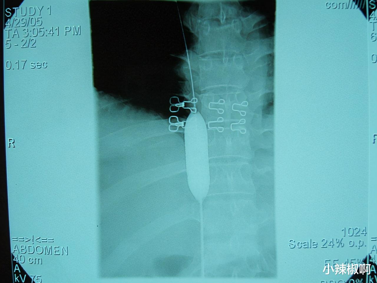 小辣椒啊 非常病例——疑难病年轻女患者崇尚科学，得到迅速治疗和长期效果