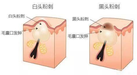 黑头|闭口、黑头、痘痘、脂肪粒……终于分清它们是什么了