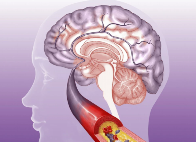 医生|46岁女子血脂从6.3到1.7,医生:2物是血脂“清理工”,别不舍得吃