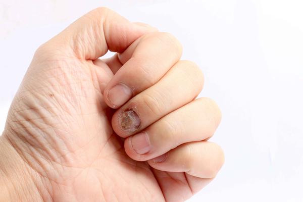 快速问医生|指甲有竖纹,代表“大病将至”?留个心眼,可能身体生病了