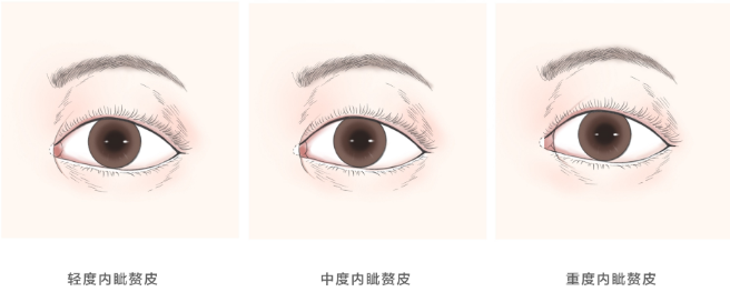 史迎军眼整形|史迎军眼整形 | 开眼角容易留疤、回缩吗？眼角到底该不该开？