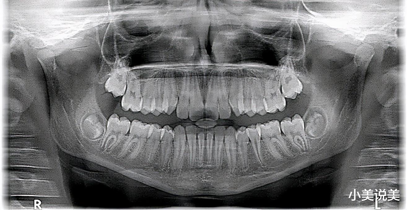 小美说美 智齿不痛的话可以不拔吗