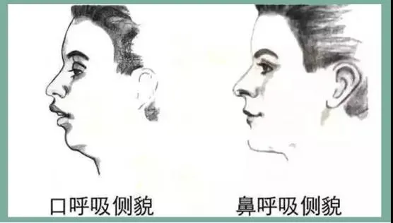 小柒育儿|wenno: 孩子鼻腔内竟有活物!鼻塞久会影响智力听力!