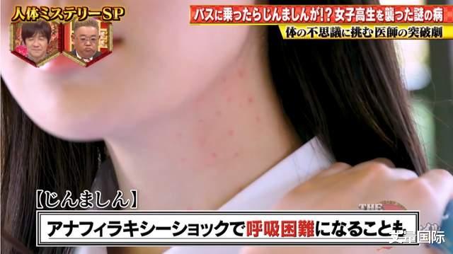 医生|日本女学生搭公车时出红疹昏迷不醒，医生发现她对“振动过敏”