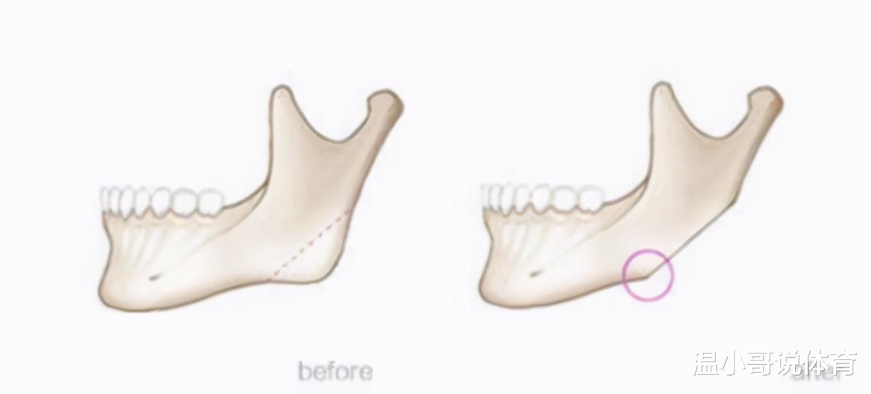 太湖|削骨的明星后悔了吗？后遗症一大堆，小方脸反倒成了真香系列！