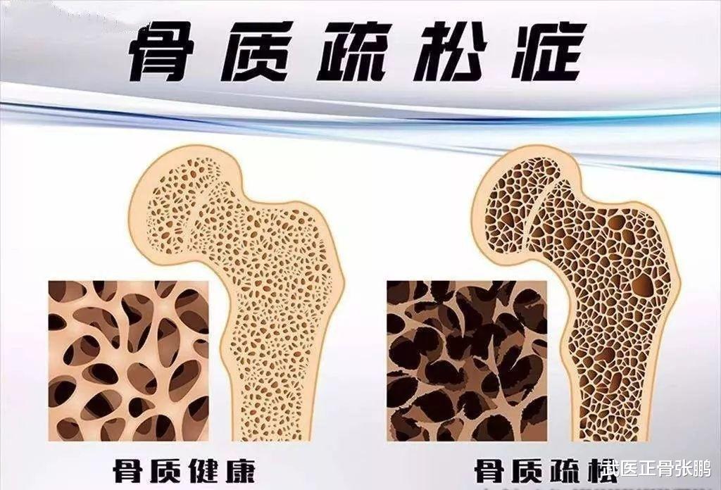安神|56岁大姐仅用1年,骨密度恢复正常,医生直呼:“211”法则果然妙