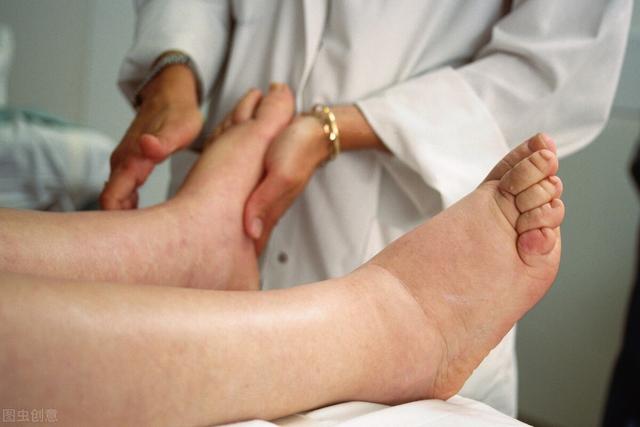 疾病|体内有癌,手脚先知道!四肢若有这5个异常症状,提醒该做检查了