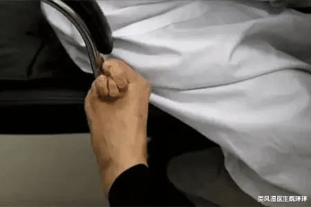 医生|把握类风湿治疗的“黄金期”,避免关节变形不可逆!