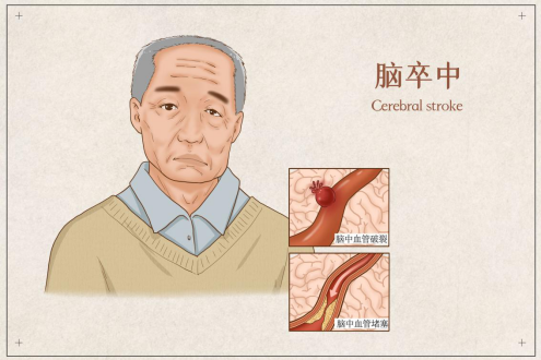 芹菜|源于芹菜籽的脑血管创新药：丁苯酞