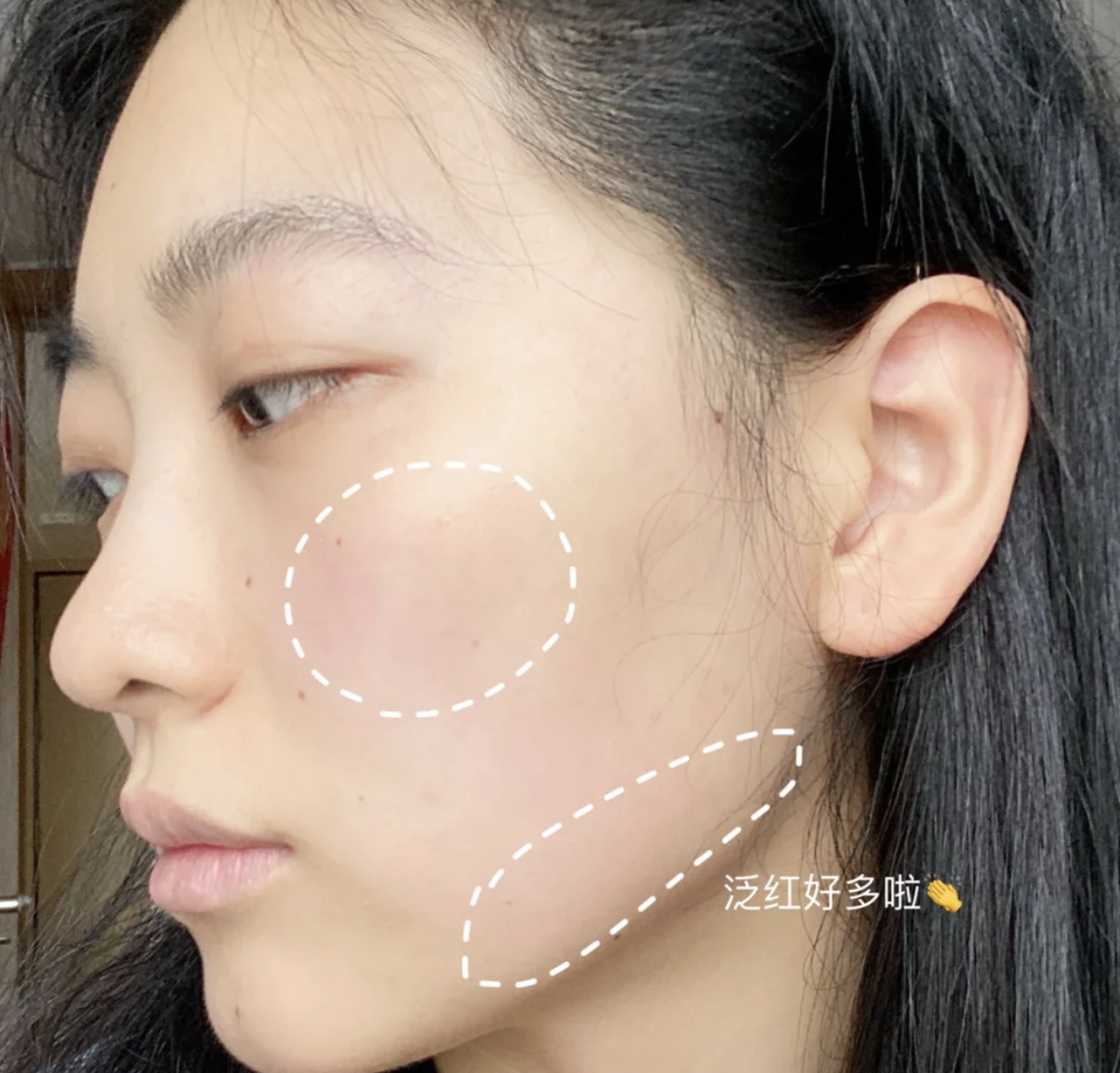 蒂尔施|女生皮肤“秋敏”5大特征,别傻乎乎当成闭口,难怪肌肤越来越糟