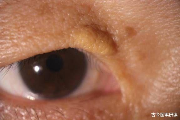 血栓|血脂“代谢剂”已发现，不是白开水，没事随便吃点，血脂回归正常