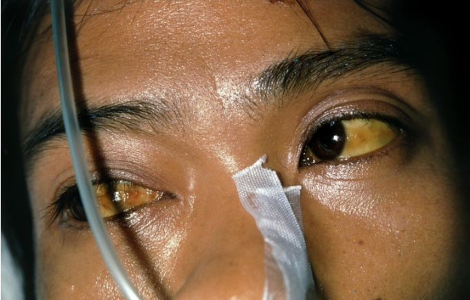 39健康网|吃一口顶10斤榴莲，肝科主任：你若喜欢喝，趁你睡着肝毒自动排光