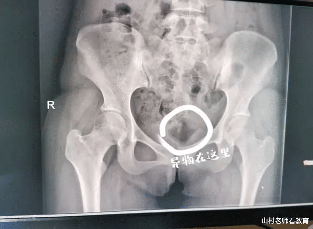 医生 大学生情侣为寻刺激，将长5CM异物塞入一个月，医生的话让人脸红