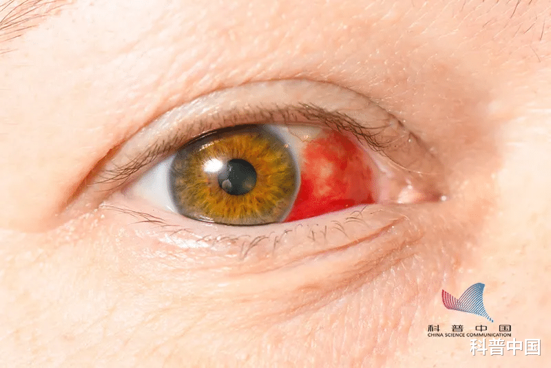 疾病|眼白變黃，表示肝有問題？注意！出現這幾種，趕緊就醫