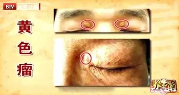 枸杞|“溶栓高手”公布，并非枸杞，平时尽情吃，血管干净，远离头晕失眠