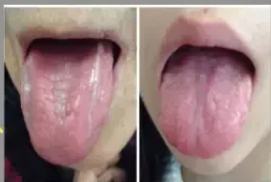 高血壓|身體最常見的4種“虛”，后附解決方法