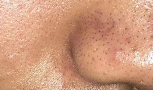 黑头|黑头没救了,别瞎说!