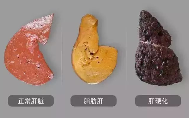 健脾|肝硬化來臨并非悄無聲息，醫生忠告，身體3處“異?！?，早做肝檢查