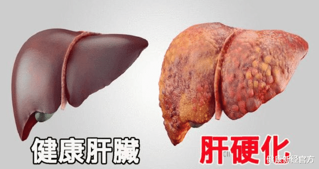 健康新经官方 28岁小伙频繁腹泻，诊断为肝硬化，医生：这“2事”怎能如此放纵？