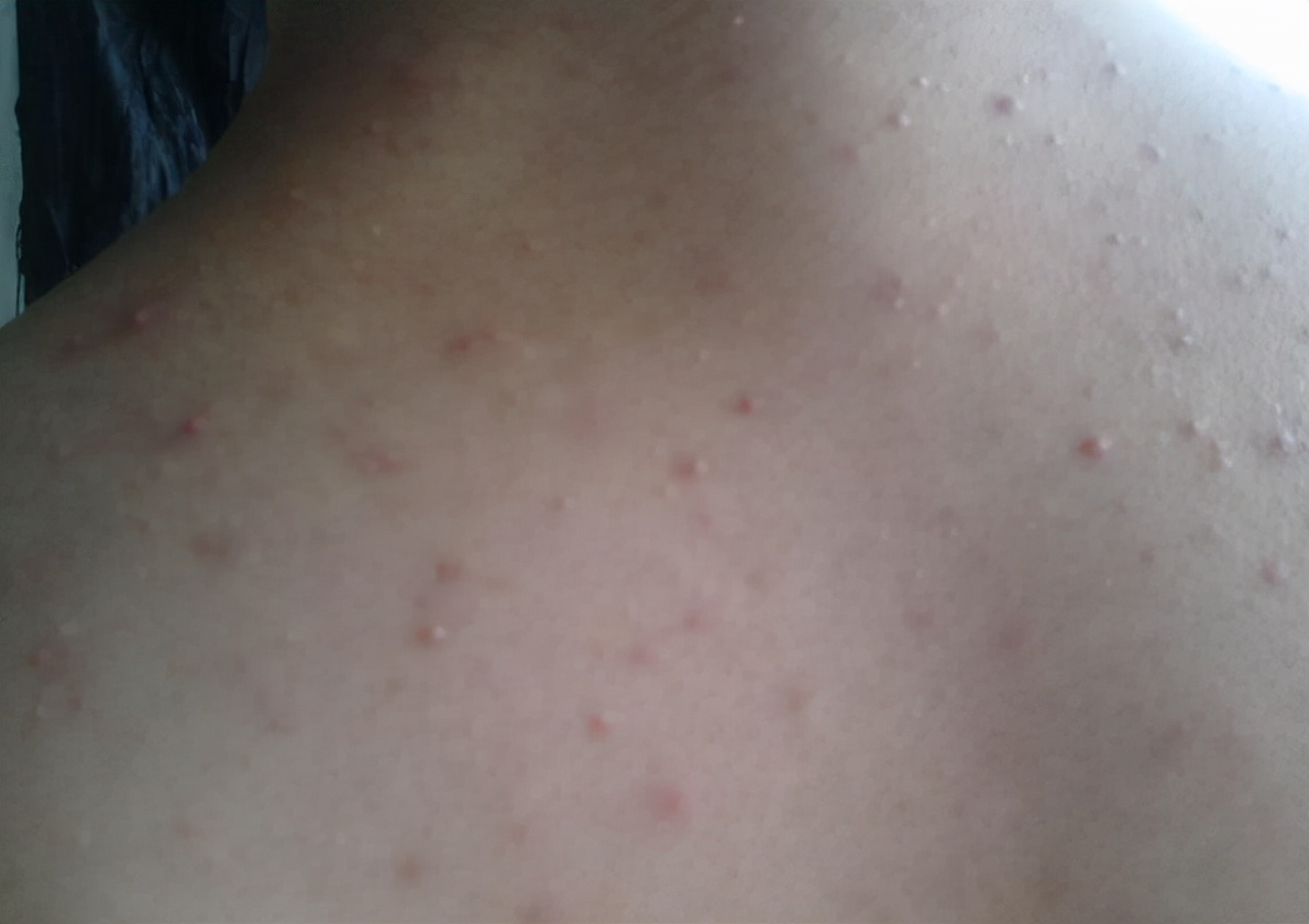 转氨酶|16岁女孩身上长满“疙瘩”,确诊HPV阳性,医生:无知,这东西怎么能用!