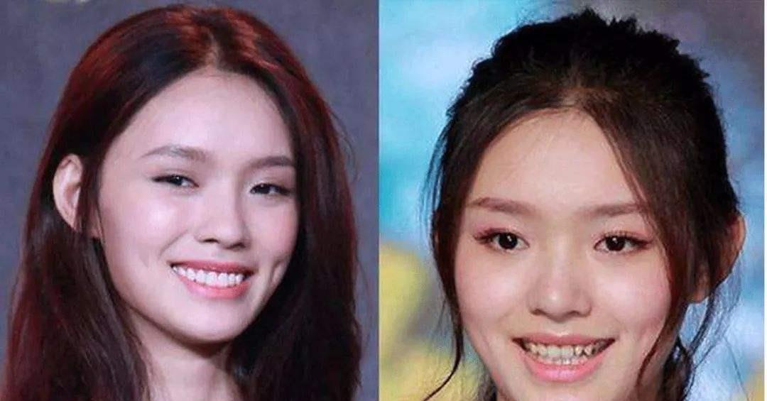 刘涛|明星“假牙”大pk：刘涛花300万整牙，吴昕的牙齿变黢黑