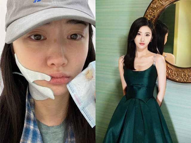 景甜|景甜素颜曝光认不出，怼脸自拍双眼皮疤痕明显，曾大方承认整容