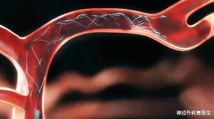 神经外科高医生 脑动脉瘤治疗办法
