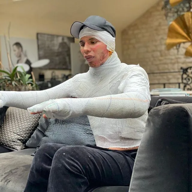 InsDaily 他被嘲“整形怪”10年！如今自曝毁容烧伤照，网友：又来炒作！