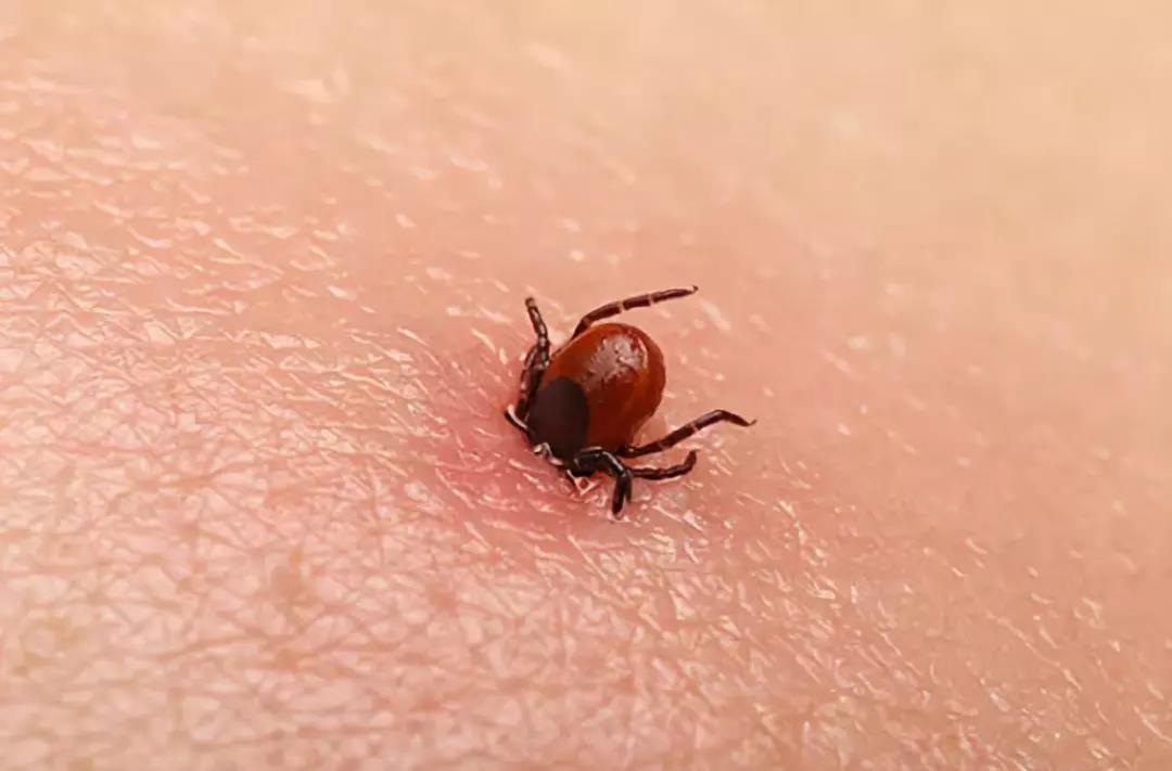 90育儿|夏天蜱虫多，孩子被咬后别硬拔，宝妈学会三个急救法，医生都夸好