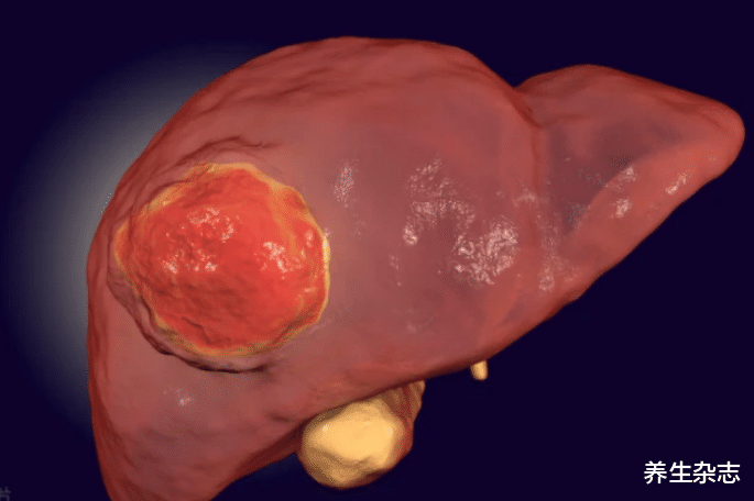 肝癌|肝癌发现即晚期？肝科专家：不论男女，上厕所有2种异常，早做检查