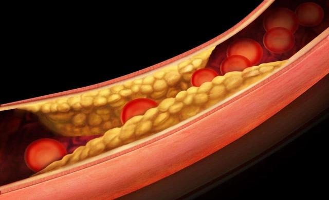 铠甲护士|“甘油三酯大户”或已公布，50岁以后，这几种食物或要少碰