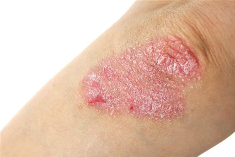 39健康网|带状疱疹、湿疹，用什么药好得快？常见皮肤病「用药指南」来了
