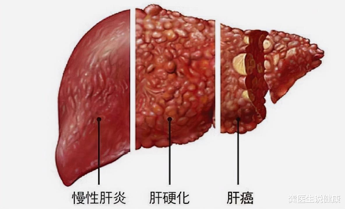 肝癌|72岁老中医：肝癌多半是“拖”出来的，身体出现4种情况，早做检查为妙