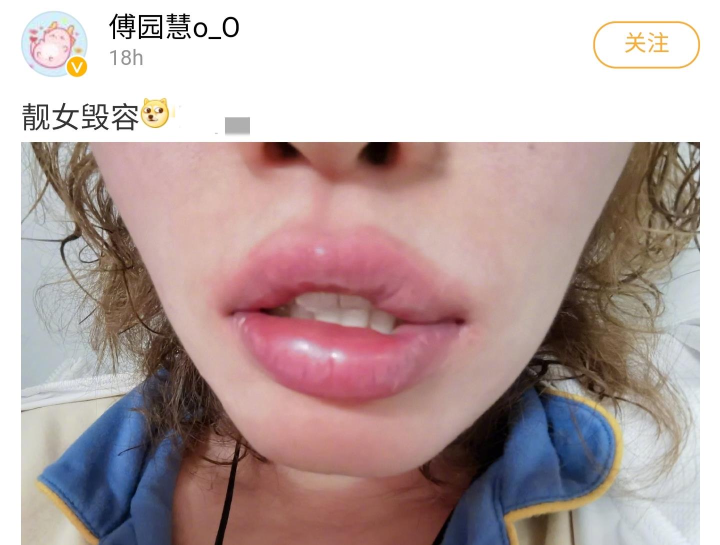 傅园慧|25岁傅园慧自曝毁容，嘴巴肿成香肠闭不上，胸前一片红肿