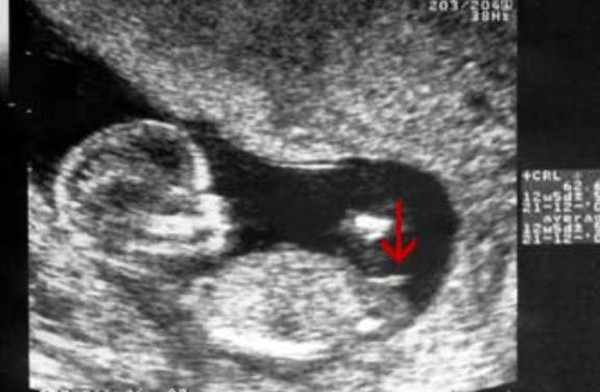 怀孕妈妈知识宝典|nt图有三条线是怎么回事，和男女有关吗？