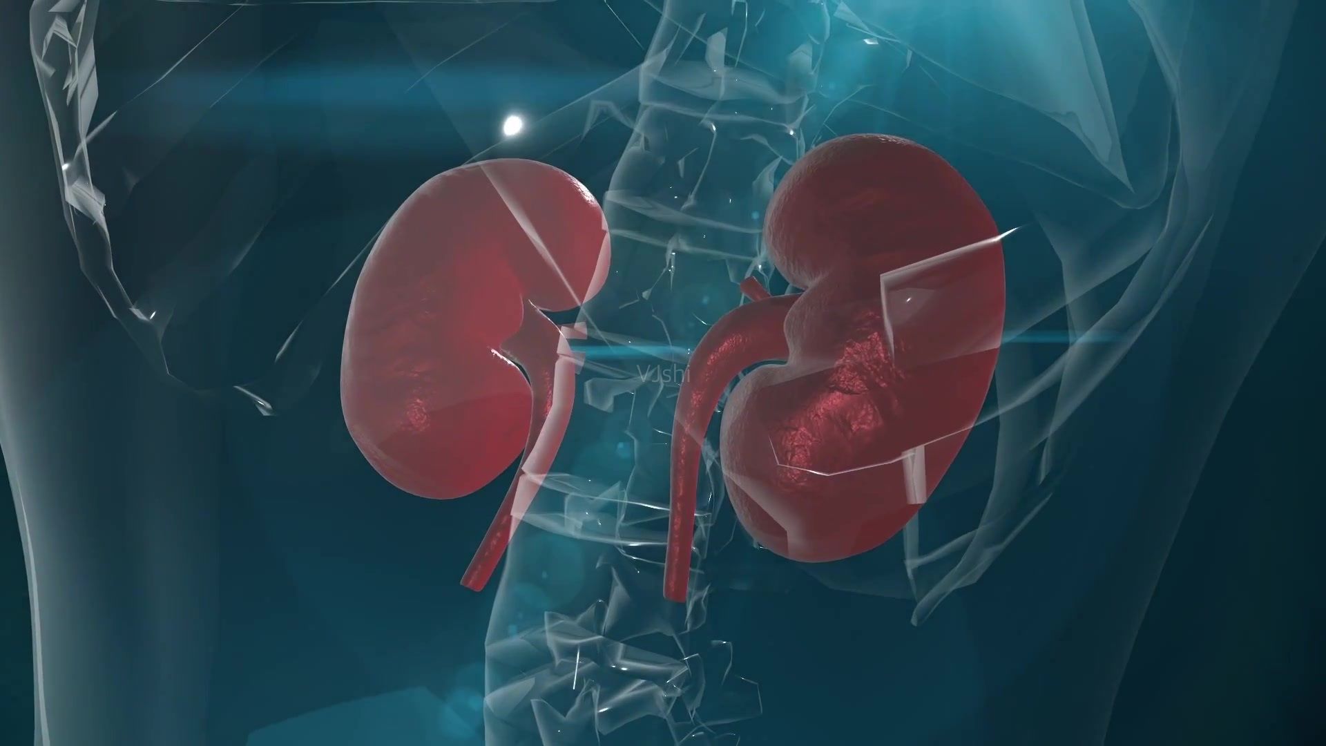 肾结石|从来没在意过的“小石头”，却把我的肾脏搞坏了