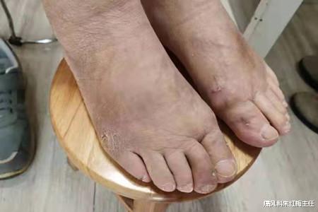 经络|常做这六件事，帮助肾脏排出尿酸